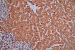 IHC image of CSB-RA021915MA1HU diluted at 1:50 and staining in paraffin-embedded human liver cancer performed on a Leica BondTM system. After dewaxing and hydration,  antigen retrieval was mediated by high pressure in a citrate buffer (pH 6.0). Section was blocked with 10% normal goat serum 30min at RT. Then primary antibody (1% BSA) was incubated at 4°C overnight. The primary is detected by a Goat anti-Mouse IgG labeled by HRP and visualized using 0.05% DAB.