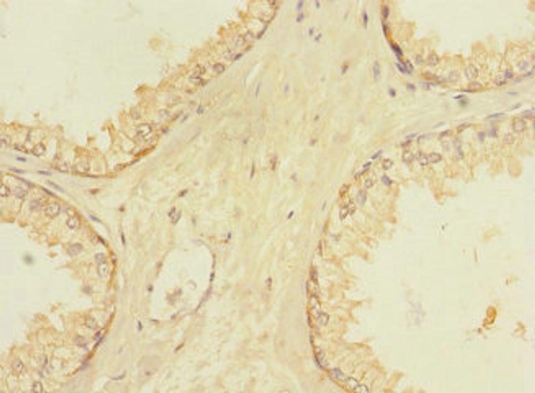 Immunohistochemistry of paraffin-embedded human prostate cancer using CSB-PA801813LA01HU at dilution of 1:100