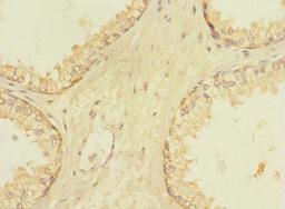 Immunohistochemistry of paraffin-embedded human prostate cancer using CSB-PA801813LA01HU at dilution of 1:100