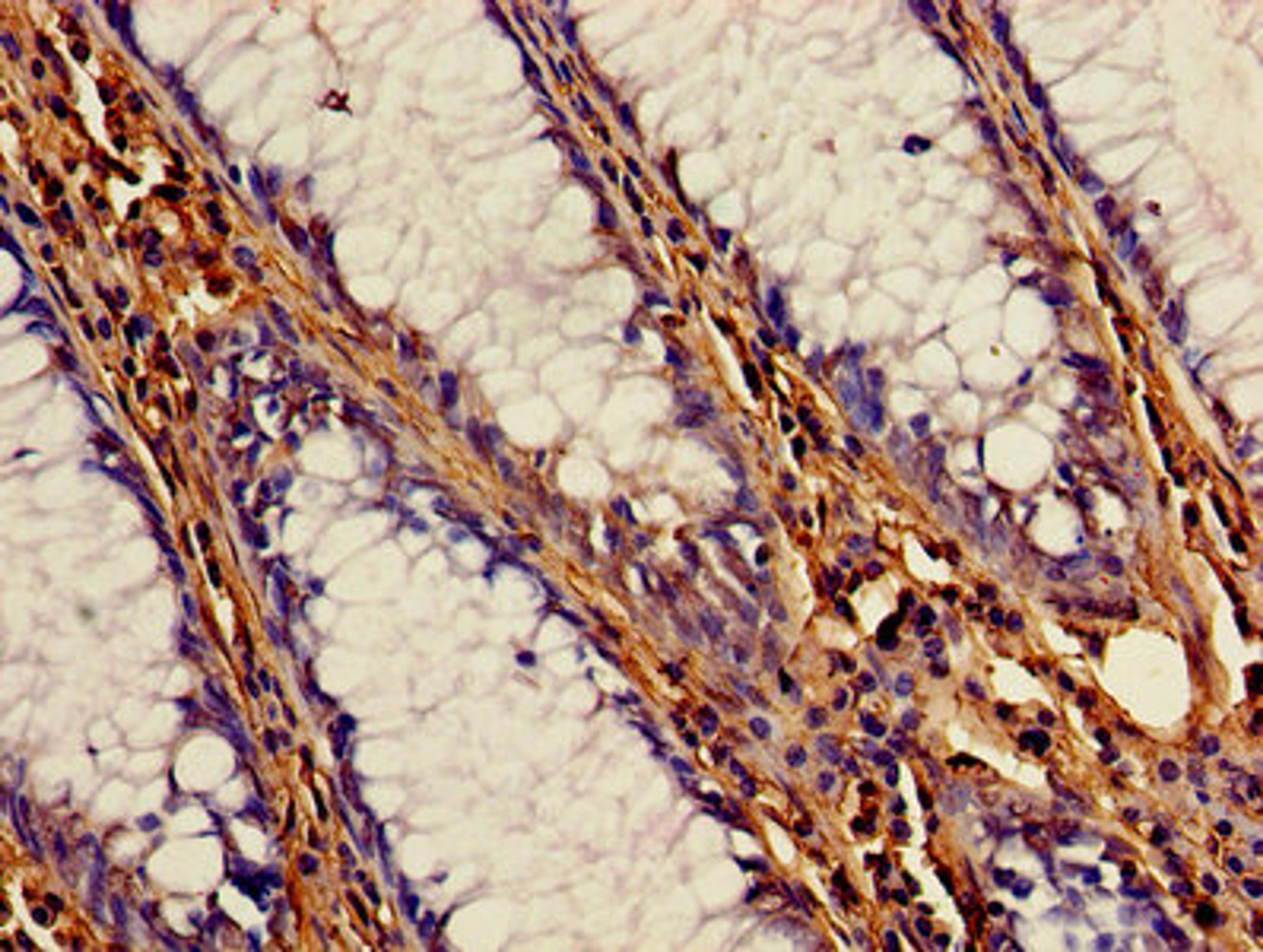 Immunohistochemistry of paraffin-embedded human colon cancer using CSB-PA00224A0Rb at dilution of 1:100