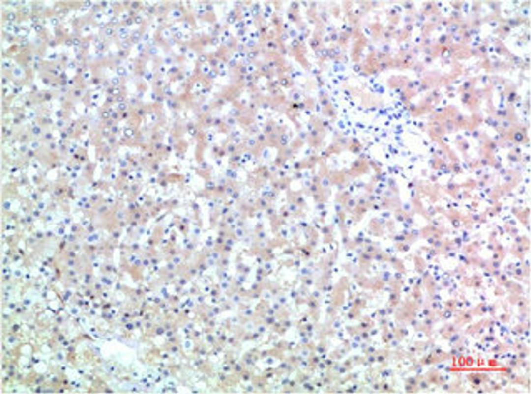 Immunohistochemical analysis of paraffin-embedded Human Liver Carcinoma Tissue using TTR Mouse mAb diluted at 1:200.