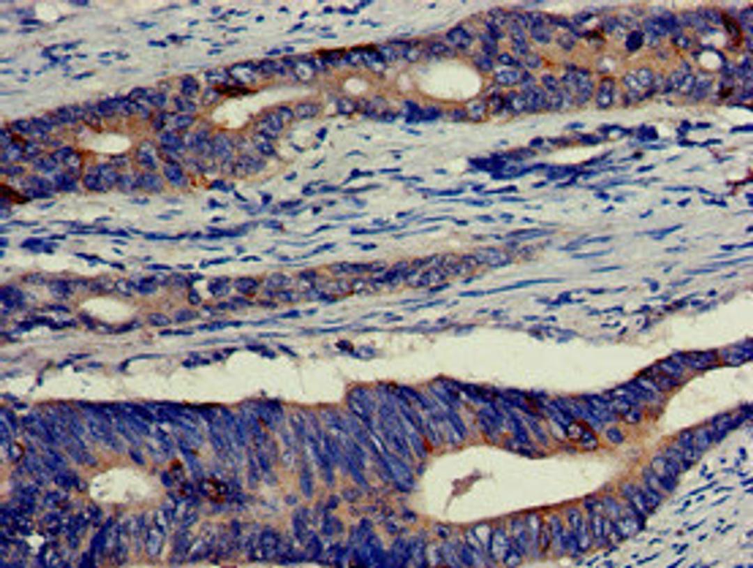 Immunohistochemistry of paraffin-embedded human colon cancer using CSB-PA007554LA01HU at dilution of 1:100