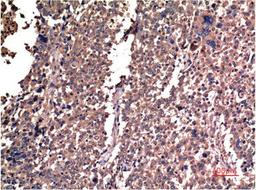 Immunohistochemical analysis of paraffin-embedded Human Lung Carcinoma Tissue using Cyclin B1 Mouse mAb diluted at 1:200.