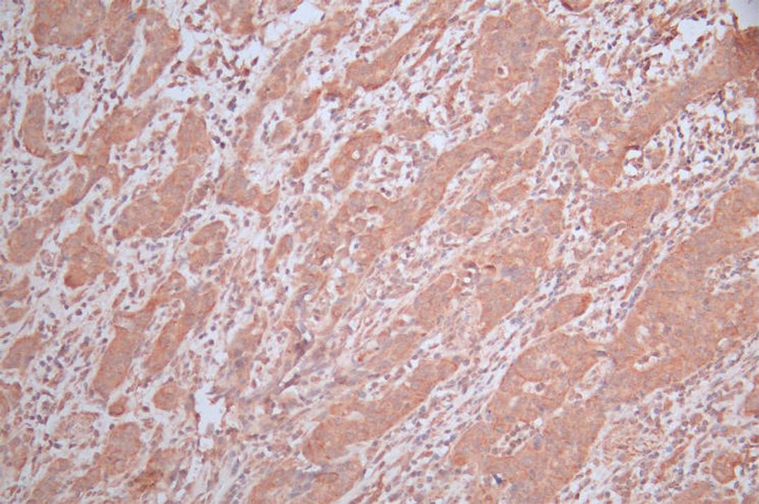 IHC image of CSB-RA892357MA1HU diluted at 1:600 and staining in paraffin-embedded human bladder cancer performed on a Leica BondTM system. After dewaxing and hydration,  antigen retrieval was mediated by high pressure in a citrate buffer (pH 6.0). Section was blocked with 10% normal goat serum 30min at RT. Then primary antibody (1% BSA) was incubated at 4°C overnight. The primary is detected by a Goat anti-Mouse IgG labeled by HRP and visualized using 0.05% DAB.