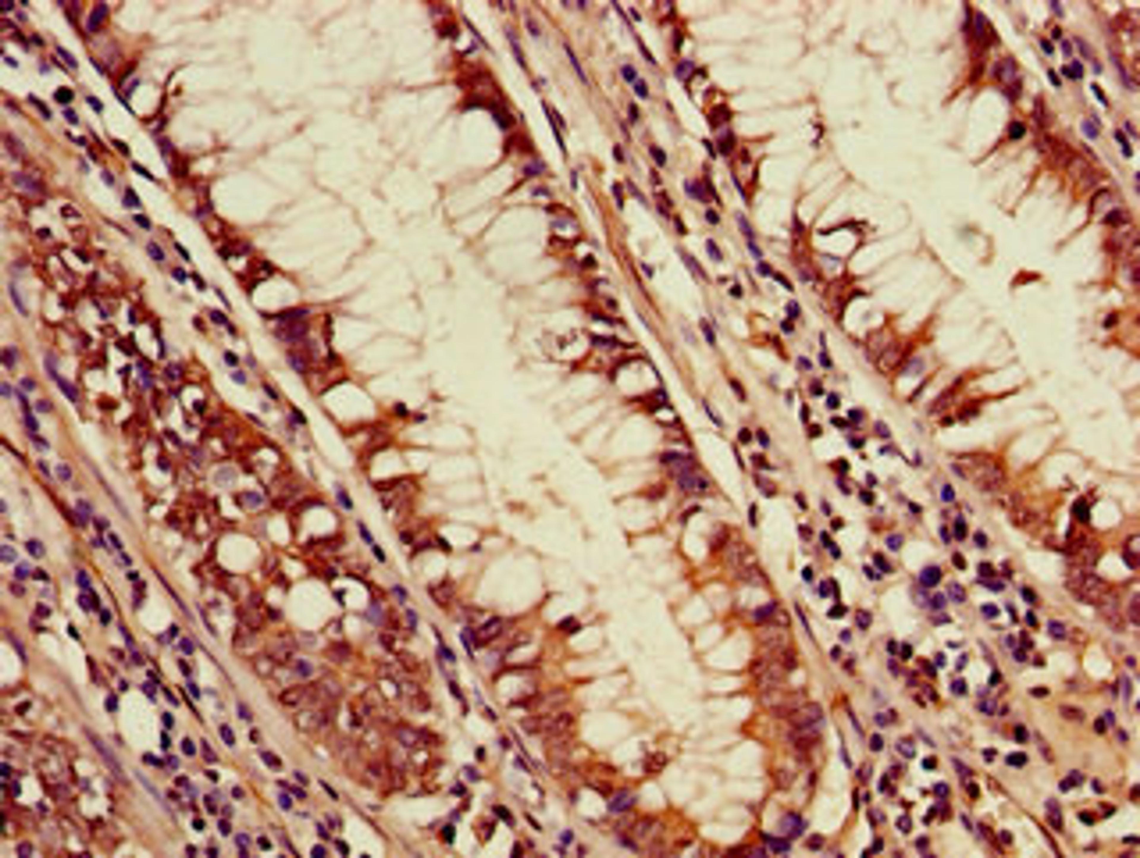 Immunohistochemistry of paraffin-embedded human colon cancer using CSB-PA643713LA01HU at dilution of 1:100