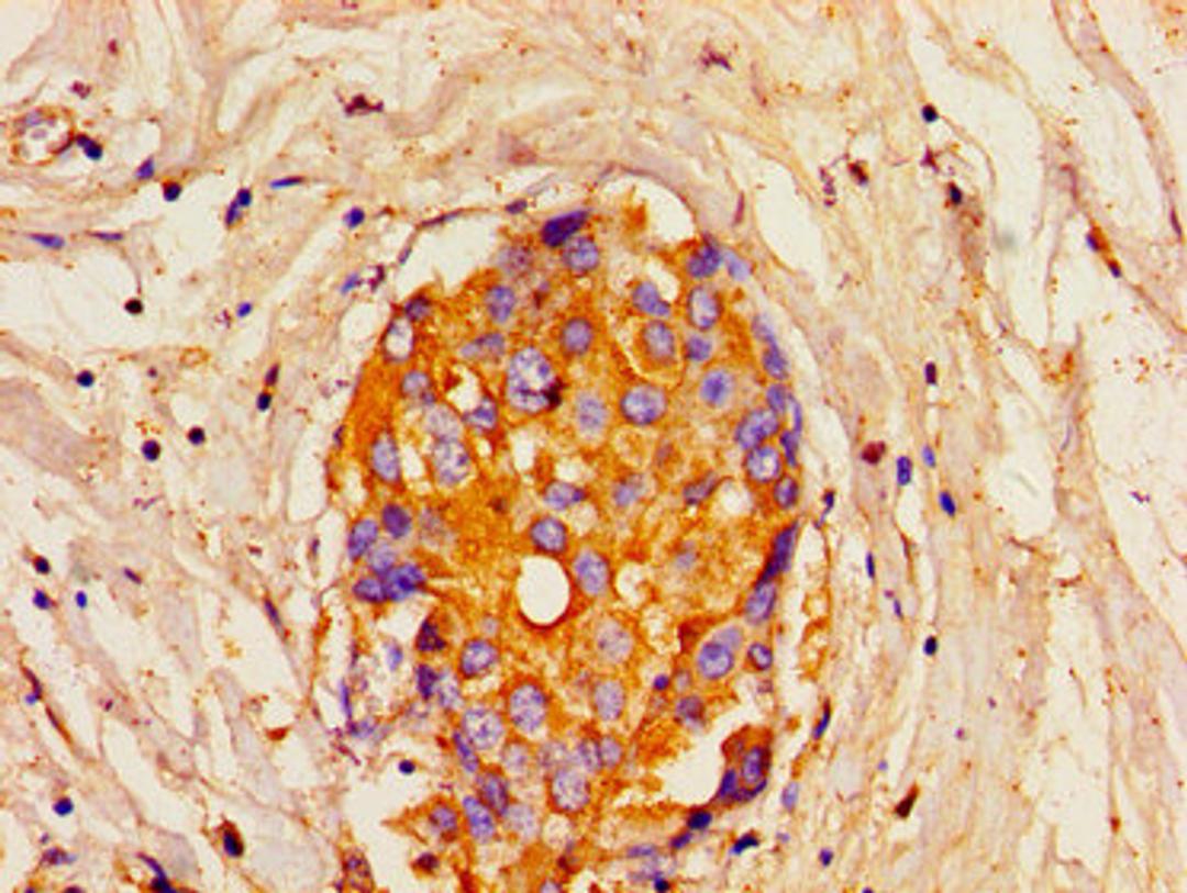 Immunohistochemistry of paraffin-embedded human breast cancer using CSB-PA614538LA01HU at dilution of 1:100