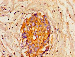 Immunohistochemistry of paraffin-embedded human breast cancer using CSB-PA614538LA01HU at dilution of 1:100