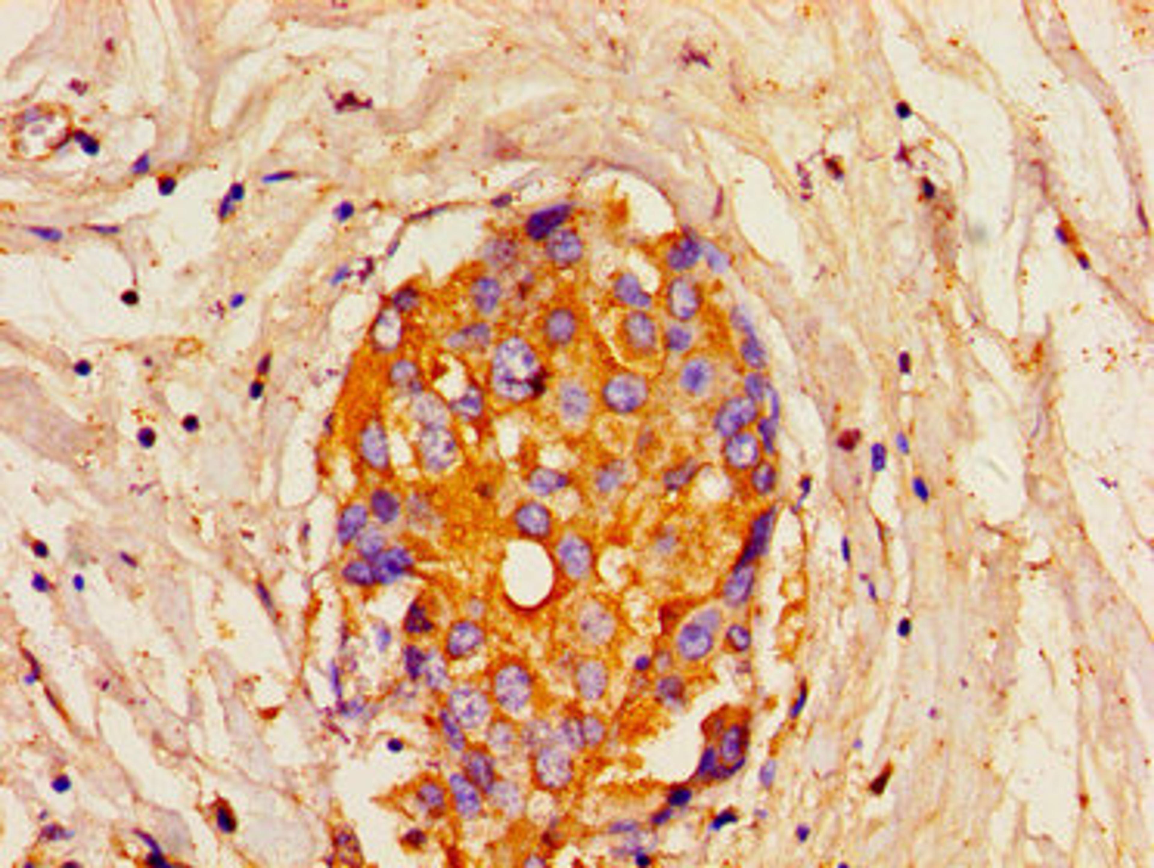 Immunohistochemistry of paraffin-embedded human breast cancer using CSB-PA614538LA01HU at dilution of 1:100