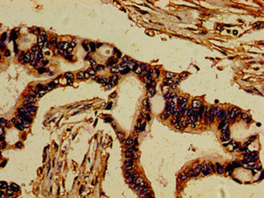 Immunohistochemistry of paraffin-embedded human pancreatic cancer using CSB-PA21119A0Rb at dilution of 1:100