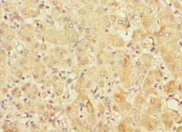 Immunohistochemistry of paraffin-embedded human liver cancer using CSB-PA822270ESR2HU at dilution of 1:100