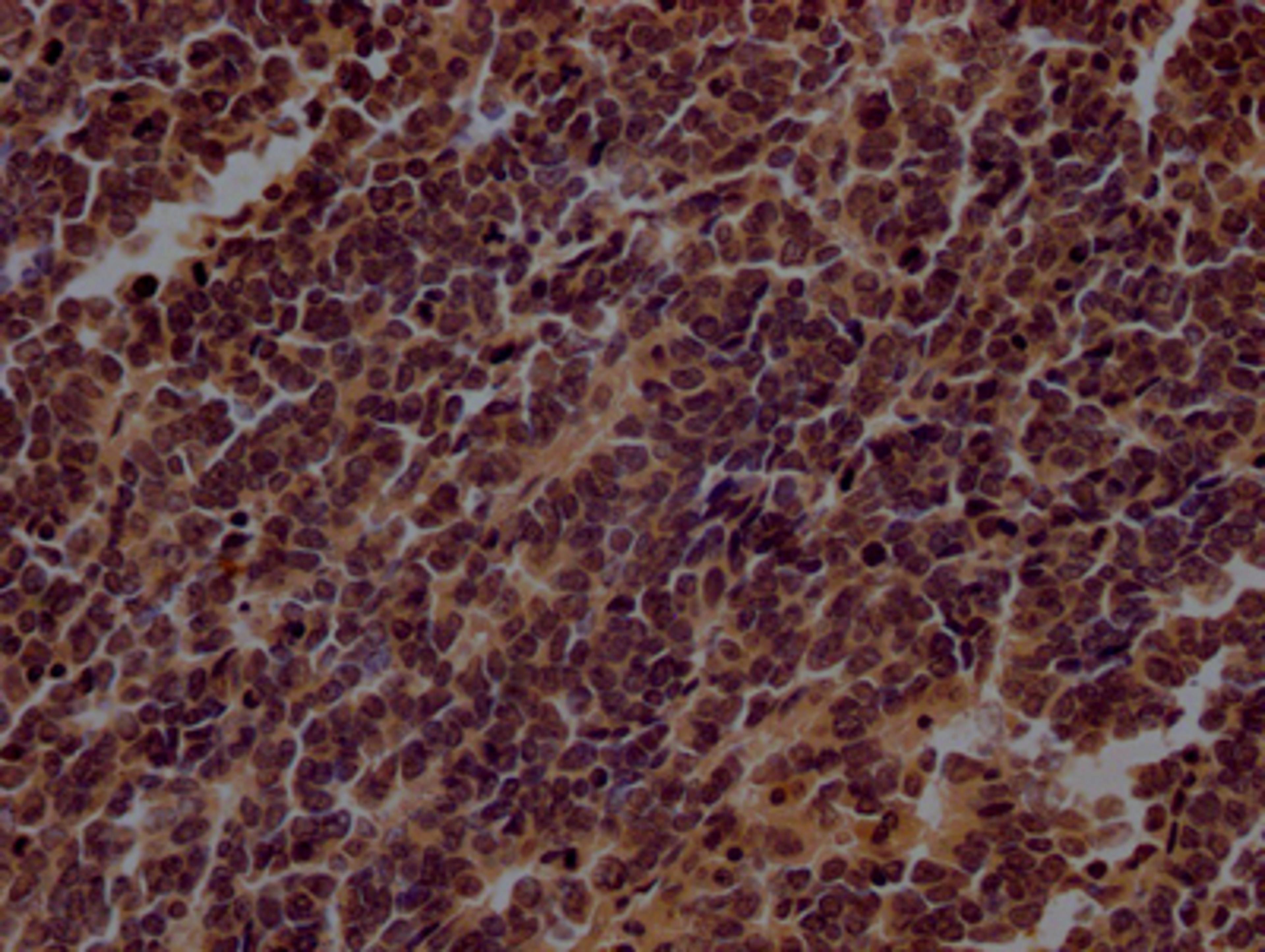 IHC image of CSB-RA798840A0HU diluted at 1:100 and staining in paraffin-embedded human lung cancer performed on a Leica BondTM system. After dewaxing and hydration, antigen retrieval was mediated by high pressure in a citrate buffer (pH 6.0). Section was blocked with 10% normal goat serum 30min at RT. Then primary antibody (1% BSA) was incubated at 4℃ overnight. The primary is detected by a Goat anti-rabbit IgG polymer labeled by HRP and visualized using 0.05% DAB.