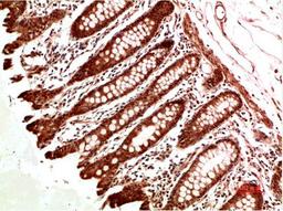 Immunohistochemical analysis of paraffin-embedded Human Colon Carcinoma Tissue using ATM Rabbit pAb diluted at 1:500.