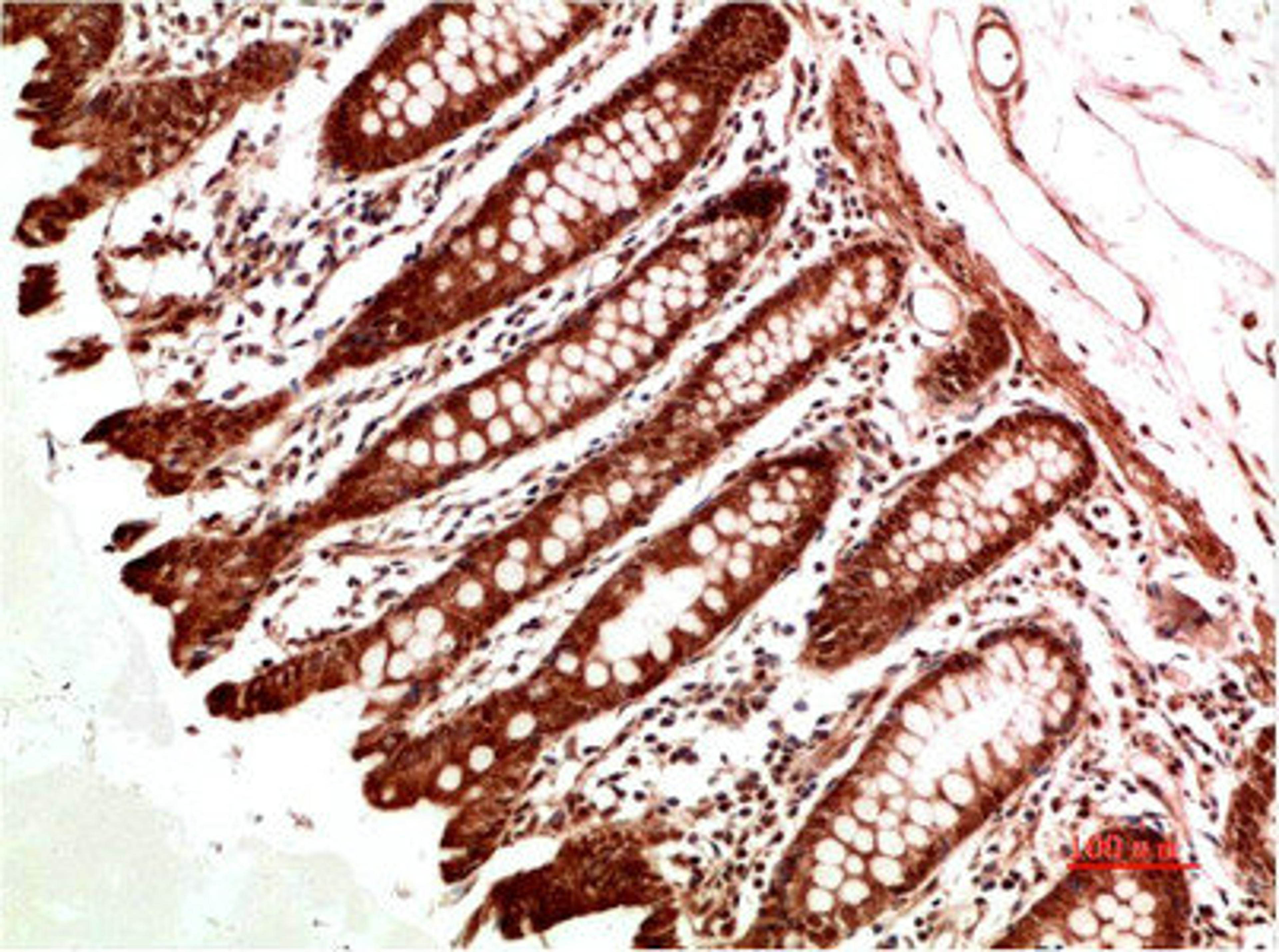Immunohistochemical analysis of paraffin-embedded Human Colon Carcinoma Tissue using ATM Rabbit pAb diluted at 1:500.