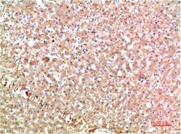 Immunohistochemical analysis of paraffin-embedded Human Liver Carcinoma Tissue using TTR Mouse mAb diluted at 1:200.