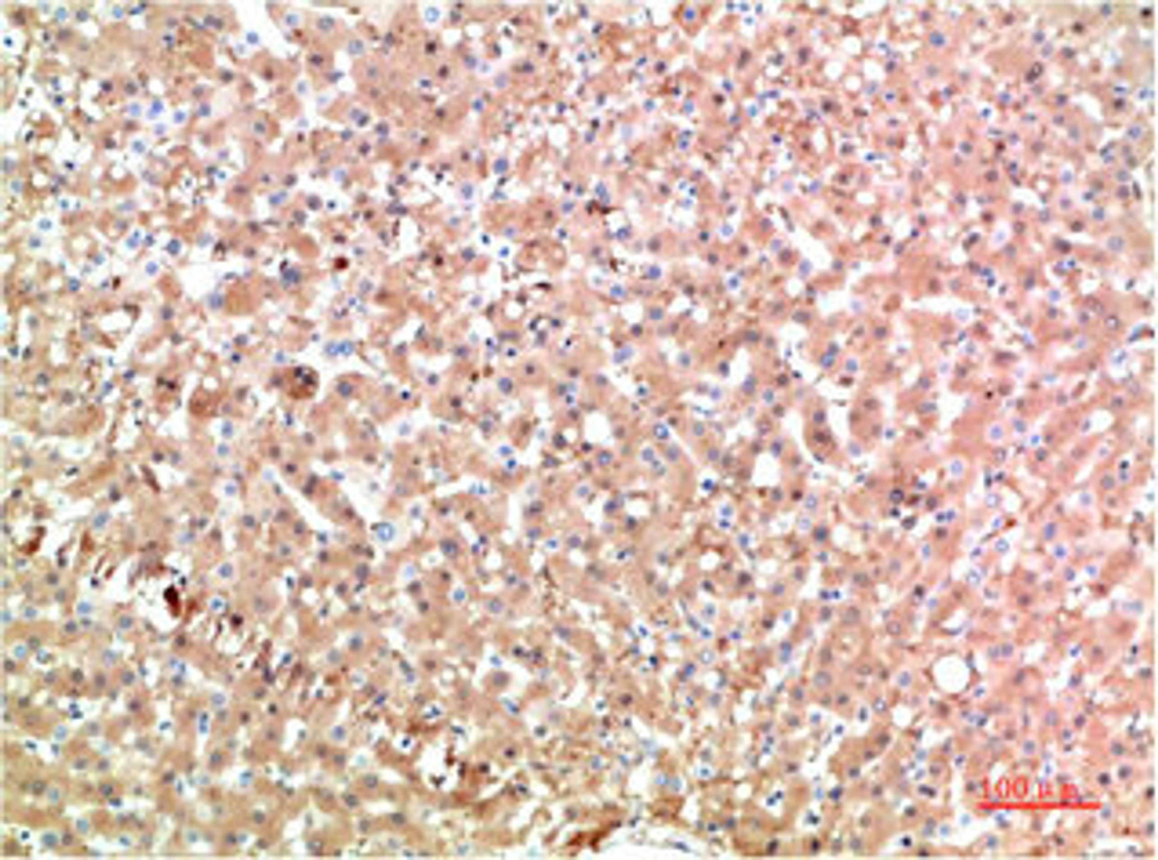 Immunohistochemical analysis of paraffin-embedded Human Liver Carcinoma Tissue using TTR Mouse mAb diluted at 1:200.