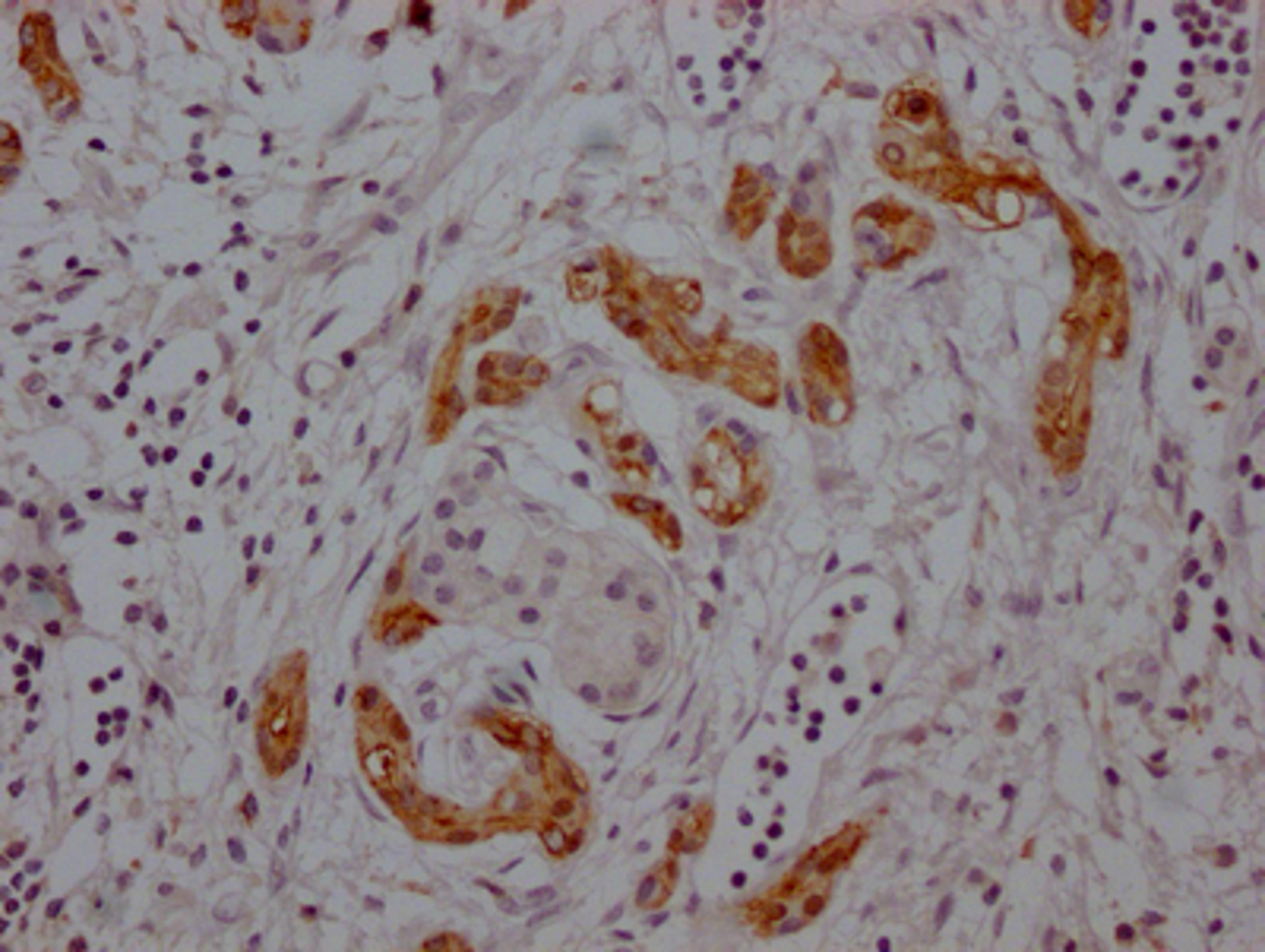 IHC image of CSB-RA276759A0HU diluted at 1:100 and staining in paraffin-embedded human pancreatic cancer performed on a Leica BondTM system. After dewaxing and hydration, antigen retrieval was mediated by high pressure in a citrate buffer (pH 6.0). Section was blocked with 10% normal goat serum 30min at RT. Then primary antibody (1% BSA) was incubated at 4℃ overnight. The primary is detected by a Goat anti-rabbit IgG polymer labeled by HRP and visualized using 0.05% DAB.