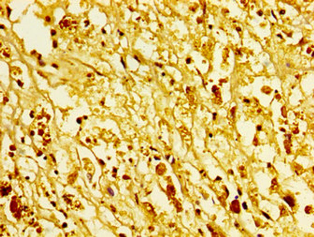IHC image of CSB-PA010378OA96ncrHU diluted at 1:5 and staining in paraffin-embedded human melanoma performed on a Leica BondTM system. After dewaxing and hydration, antigen retrieval was mediated by high pressure in a citrate buffer (pH 6.0). Section was blocked with 10% normal goat serum 30min at RT. Then primary antibody (1% BSA) was incubated at 4&deg;C overnight. The primary is detected by a biotinylated secondary antibody and visualized using an HRP conjugated SP system.