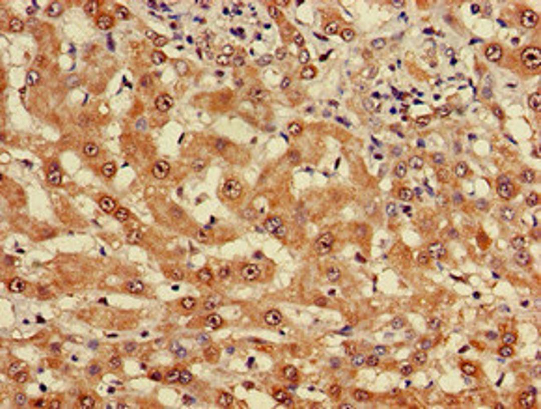 Immunohistochemistry of paraffin-embedded human liver cancer using CSB-PA622657LA01HU at dilution of 1:100