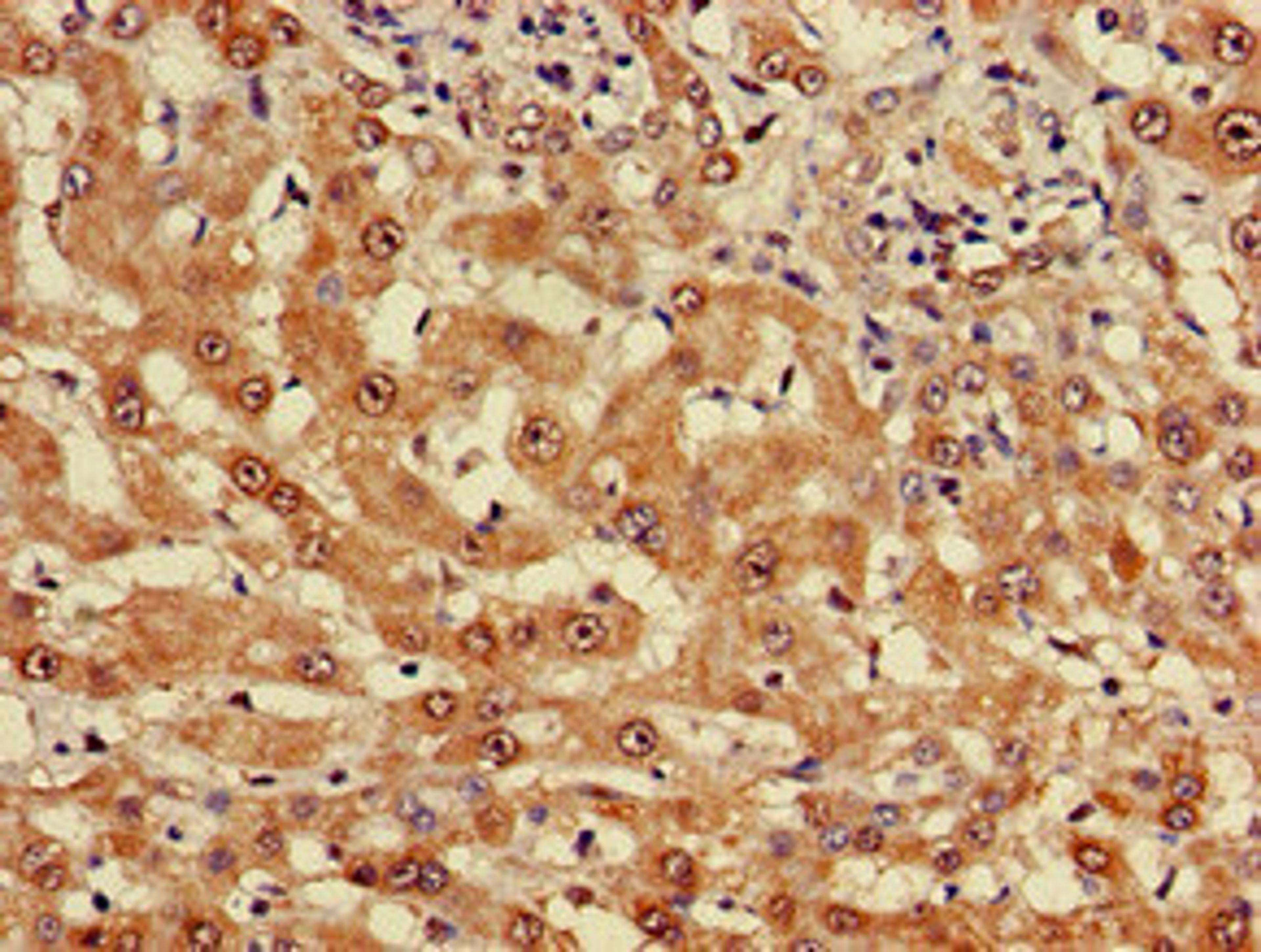 Immunohistochemistry of paraffin-embedded human liver cancer using CSB-PA622657LA01HU at dilution of 1:100