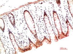 Immunohistochemical analysis of paraffin-embedded Human Colon Carcinoma Tissue using Collagen I  Mouse mAb diluted at 1:200.