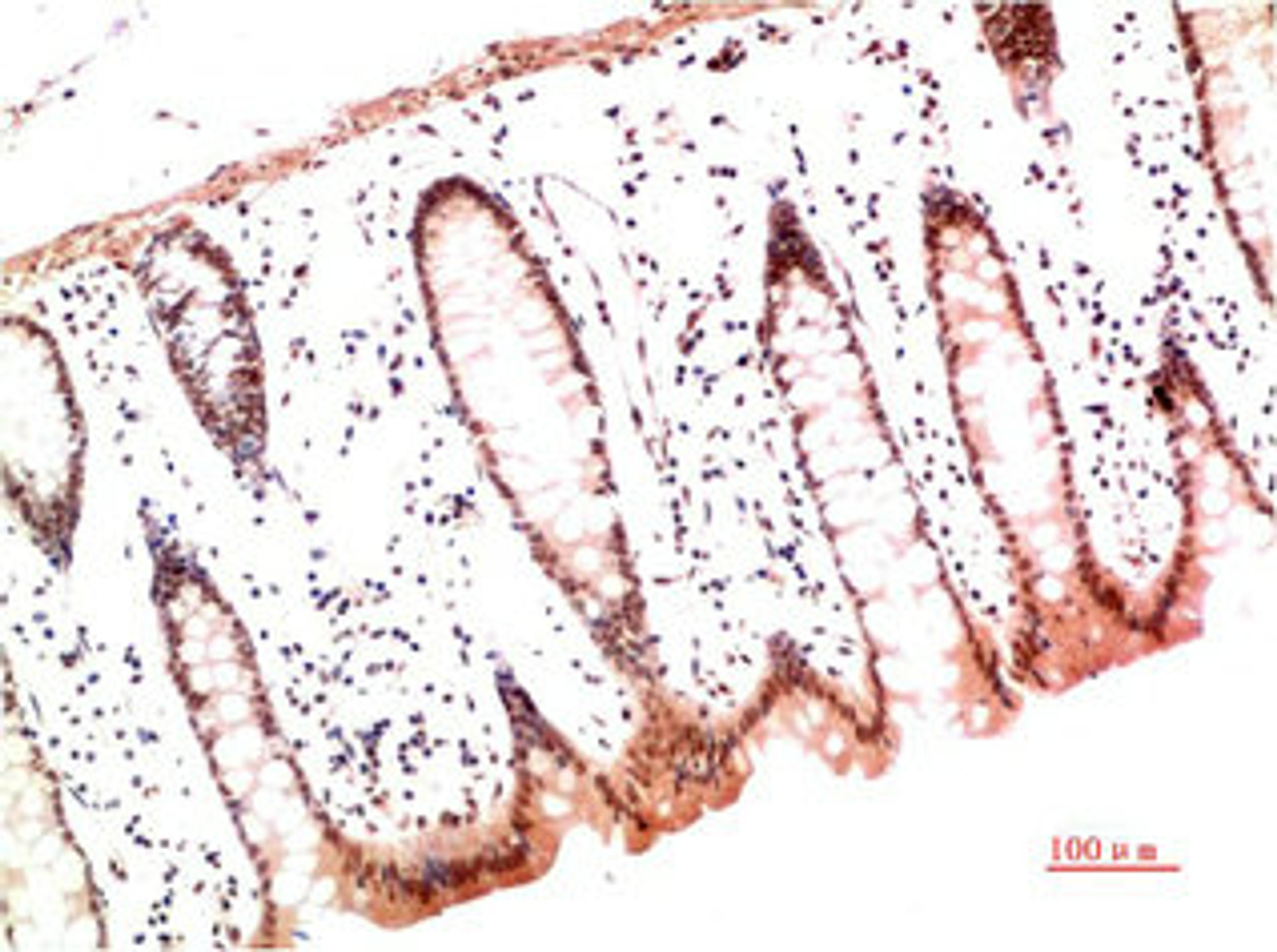 Immunohistochemical analysis of paraffin-embedded Human Colon Carcinoma Tissue using Collagen I  Mouse mAb diluted at 1:200.