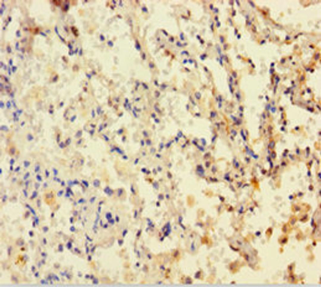 Immunohistochemistry of paraffin-embedded human lung cancer using CSB-PA006847HA01HU at dilution of 1:100