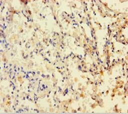 Immunohistochemistry of paraffin-embedded human lung cancer using CSB-PA006847HA01HU at dilution of 1:100