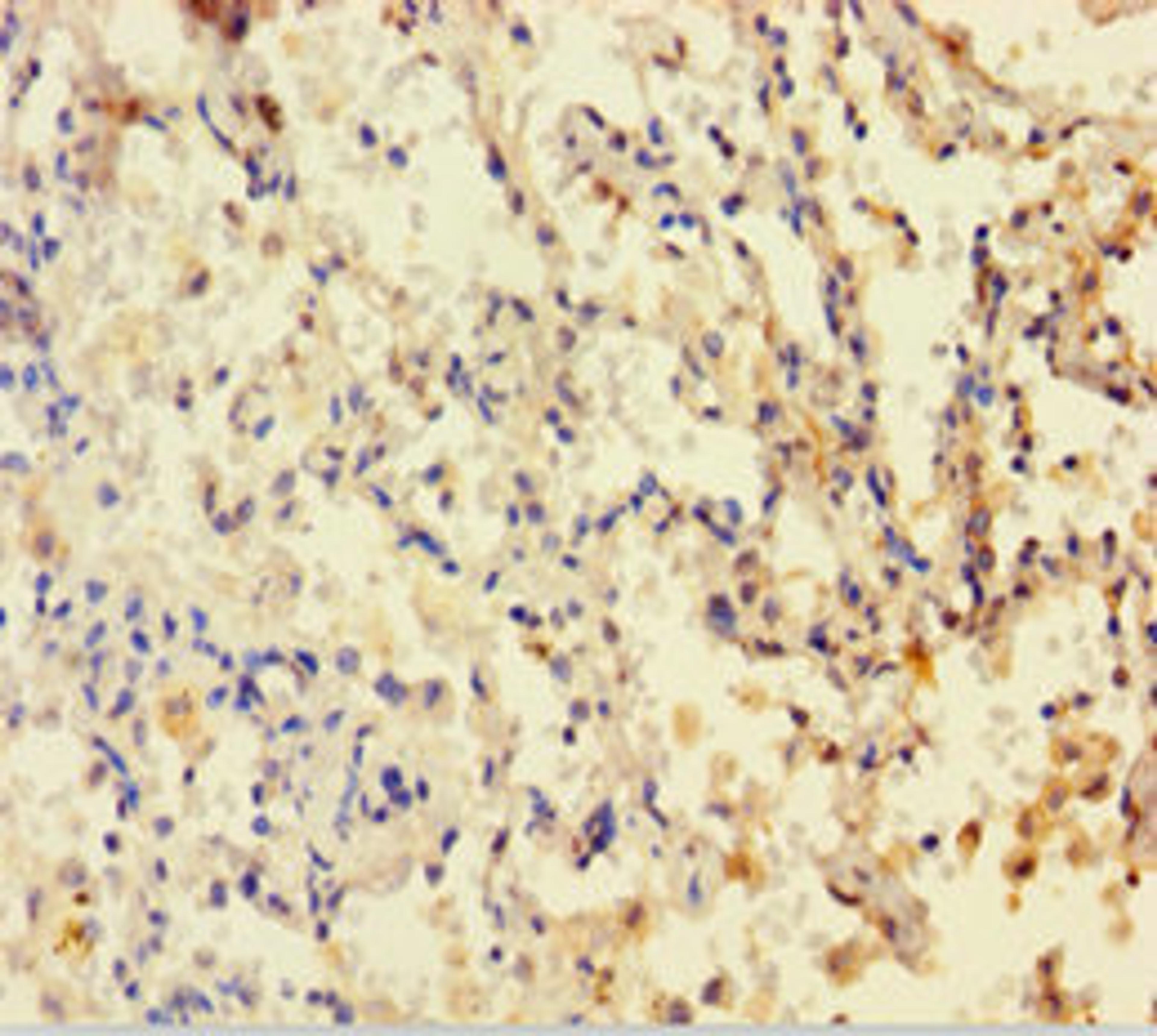 Immunohistochemistry of paraffin-embedded human lung cancer using CSB-PA006847HA01HU at dilution of 1:100