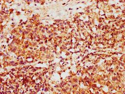 IHC image of CSB-PA884463LA01HU diluted at 1:500 and staining in paraffin-embedded human ovarian cancer performed on a Leica BondTM system. After dewaxing and hydration, antigen retrieval was mediated by high pressure in a citrate buffer (pH 6.0). Section was blocked with 10% normal goat serum 30min at RT. Then primary antibody (1% BSA) was incubated at 4°C overnight. The primary is detected by a biotinylated secondary antibody and visualized using an HRP conjugated SP system.