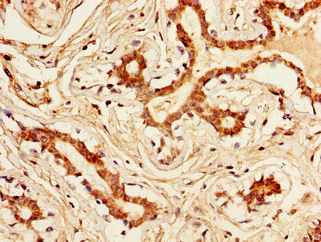 IHC image of CSB-PA012446LA01HU diluted at 1:300 and staining in paraffin-embedded human breast cancer performed on a Leica BondTM system. After dewaxing and hydration, antigen retrieval was mediated by high pressure in a citrate buffer (pH 6.0). Section was blocked with 10% normal goat serum 30min at RT. Then primary antibody (1% BSA) was incubated at 4&deg;C overnight. The primary is detected by a biotinylated secondary antibody and visualized using an HRP conjugated SP system.