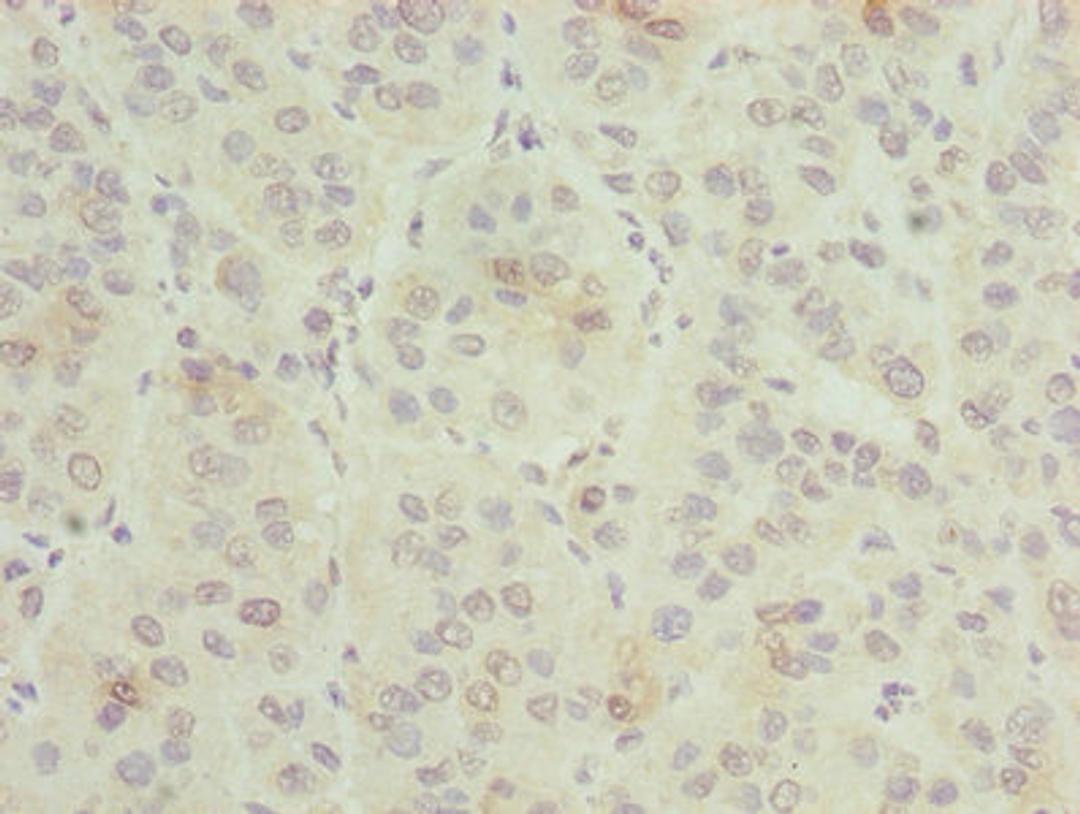 Immunohistochemistry of paraffin-embedded human liver cancer using CSB-PA009617LA01HU at dilution of 1:100