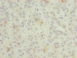 Immunohistochemistry of paraffin-embedded human liver cancer using CSB-PA009617LA01HU at dilution of 1:100
