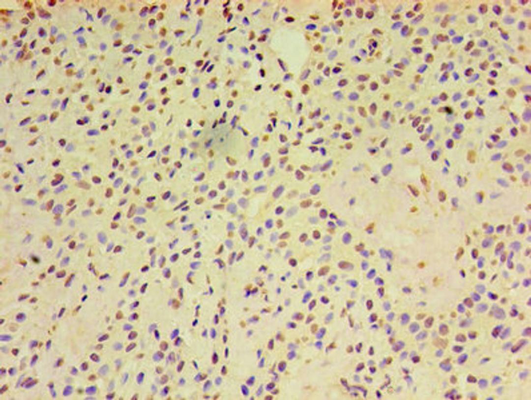 Immunohistochemistry of paraffin-embedded human breast cancer using CSB-PA001996LA01HU at dilution of 1:100
