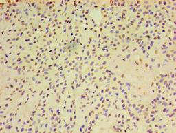 Immunohistochemistry of paraffin-embedded human breast cancer using CSB-PA001996LA01HU at dilution of 1:100