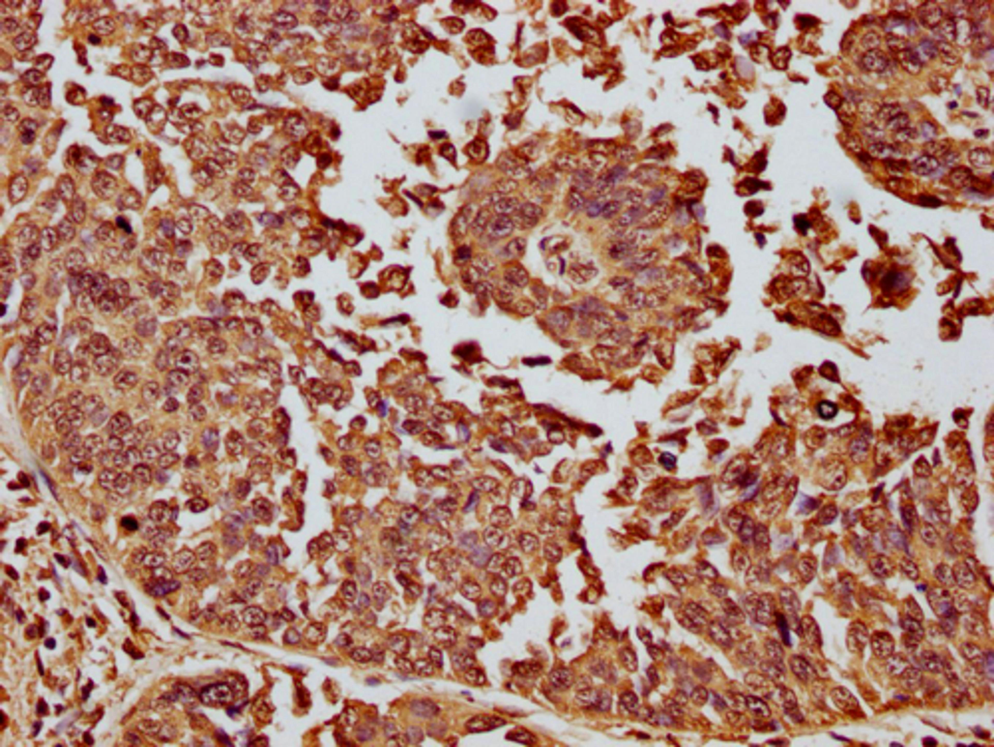 IHC image of CSB-PA010087OA11nme1HU diluted at 1:10 and staining in paraffin-embedded human cervical cancer performed on a Leica BondTM system. After dewaxing and hydration, antigen retrieval was mediated by high pressure in a citrate buffer (pH 6.0). Section was blocked with 10% normal goat serum 30min at RT. Then primary antibody (1% BSA) was incubated at 4°C overnight. The primary is detected by a biotinylated secondary antibody and visualized using an HRP conjugated SP system.