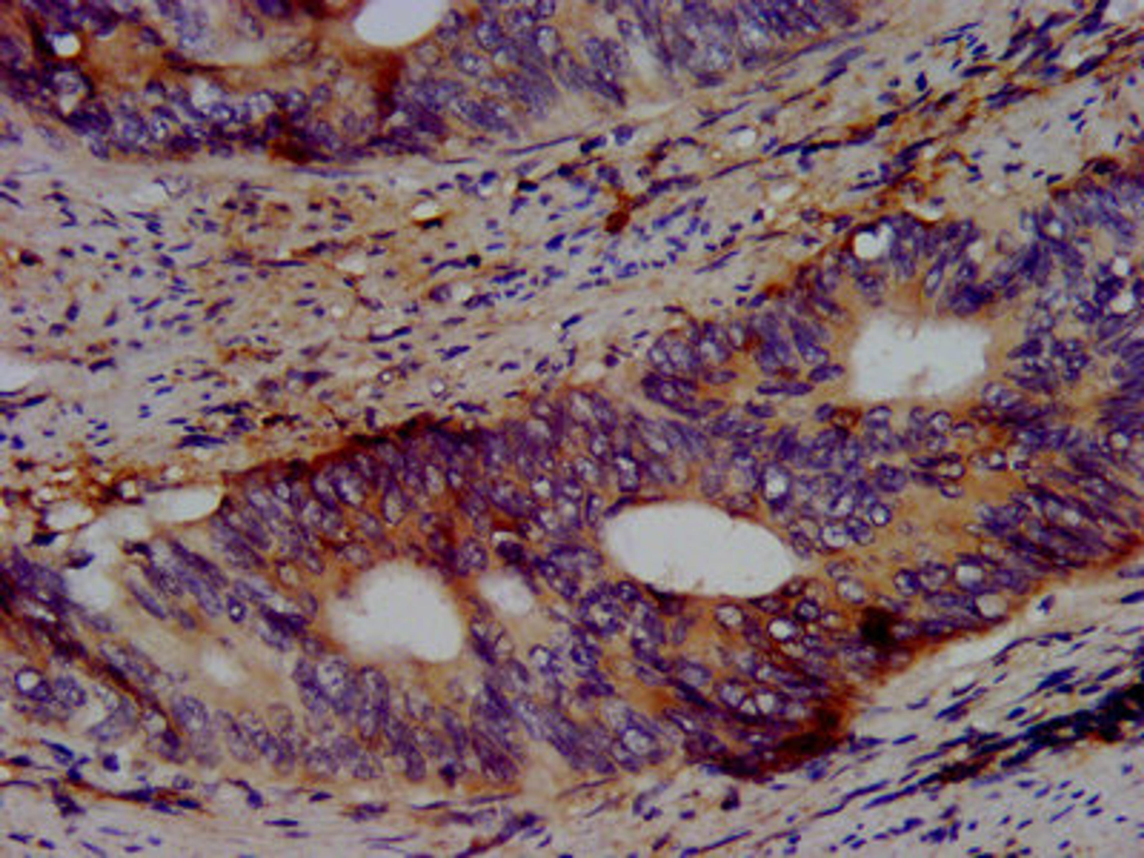 IHC image of CSB-PA848410LA01HU diluted at 1:500 and staining in paraffin-embedded human colon cancer performed on a Leica BondTM system. After dewaxing and hydration, antigen retrieval was mediated by high pressure in a citrate buffer (pH 6.0). Section was blocked with 10% normal goat serum 30min at RT. Then primary antibody (1% BSA) was incubated at 4&deg;C overnight. The primary is detected by a biotinylated secondary antibody and visualized using an HRP conjugated SP system.