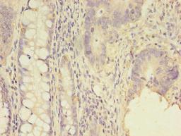 Immunohistochemistry of paraffin-embedded human colon cancer using CSB-PA020851LA01HU at dilution of 1:100