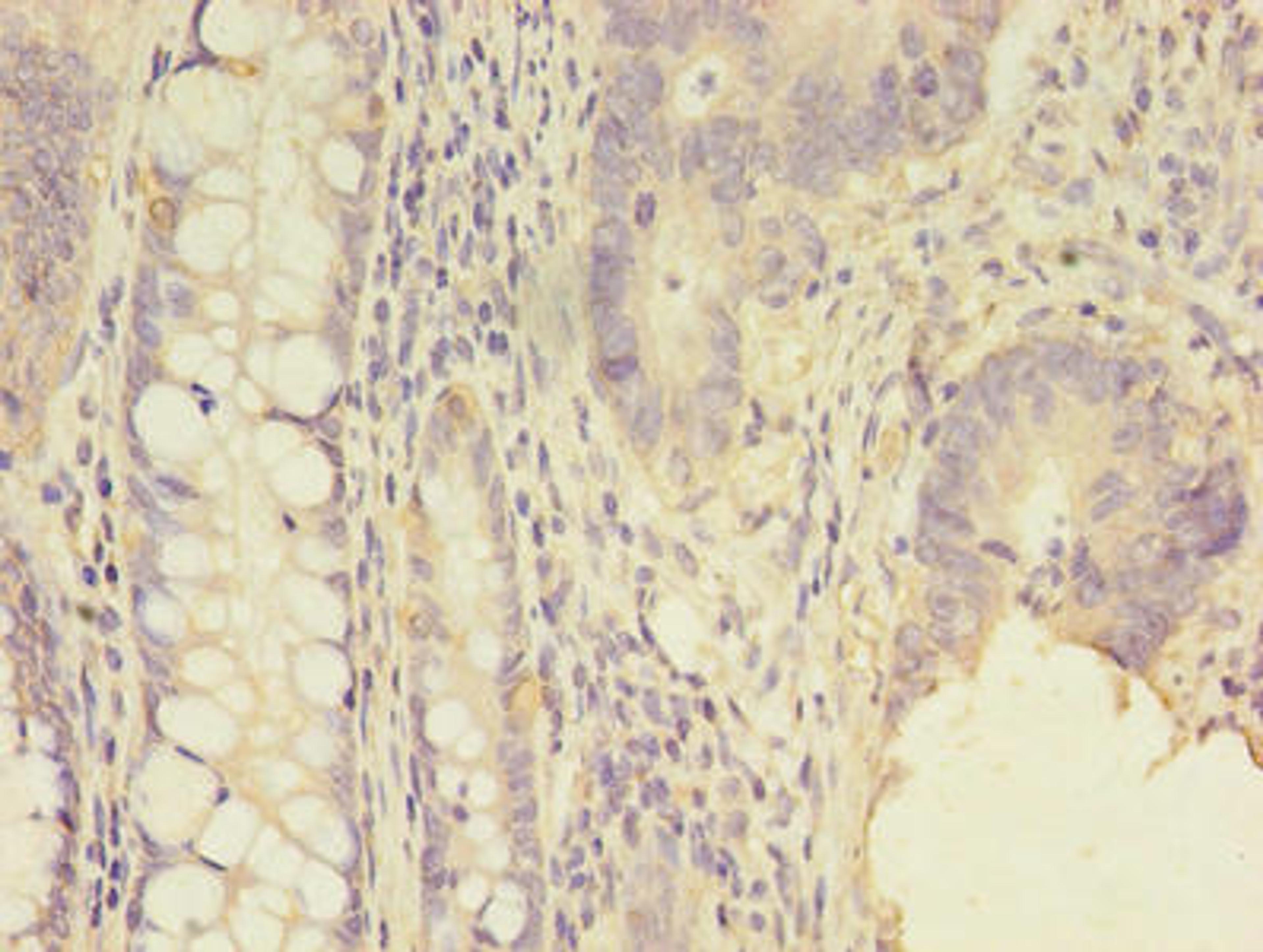 Immunohistochemistry of paraffin-embedded human colon cancer using CSB-PA020851LA01HU at dilution of 1:100