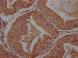 IHC image of CSB-PA28699A0Rb diluted at 1:100 and staining in paraffin-embedded human endometrial cancer performed on a Leica BondTM system. After dewaxing and hydration, antigen retrieval was mediated by high pressure in a citrate buffer (pH 6.0). Section was blocked with 10% normal goat serum 30min at RT. Then primary antibody (1% BSA) was incubated at 4°C overnight. The primary is detected by a Goat anti-rabbit polymer IgG labeled by HRP and visualized using 0.05% DAB.