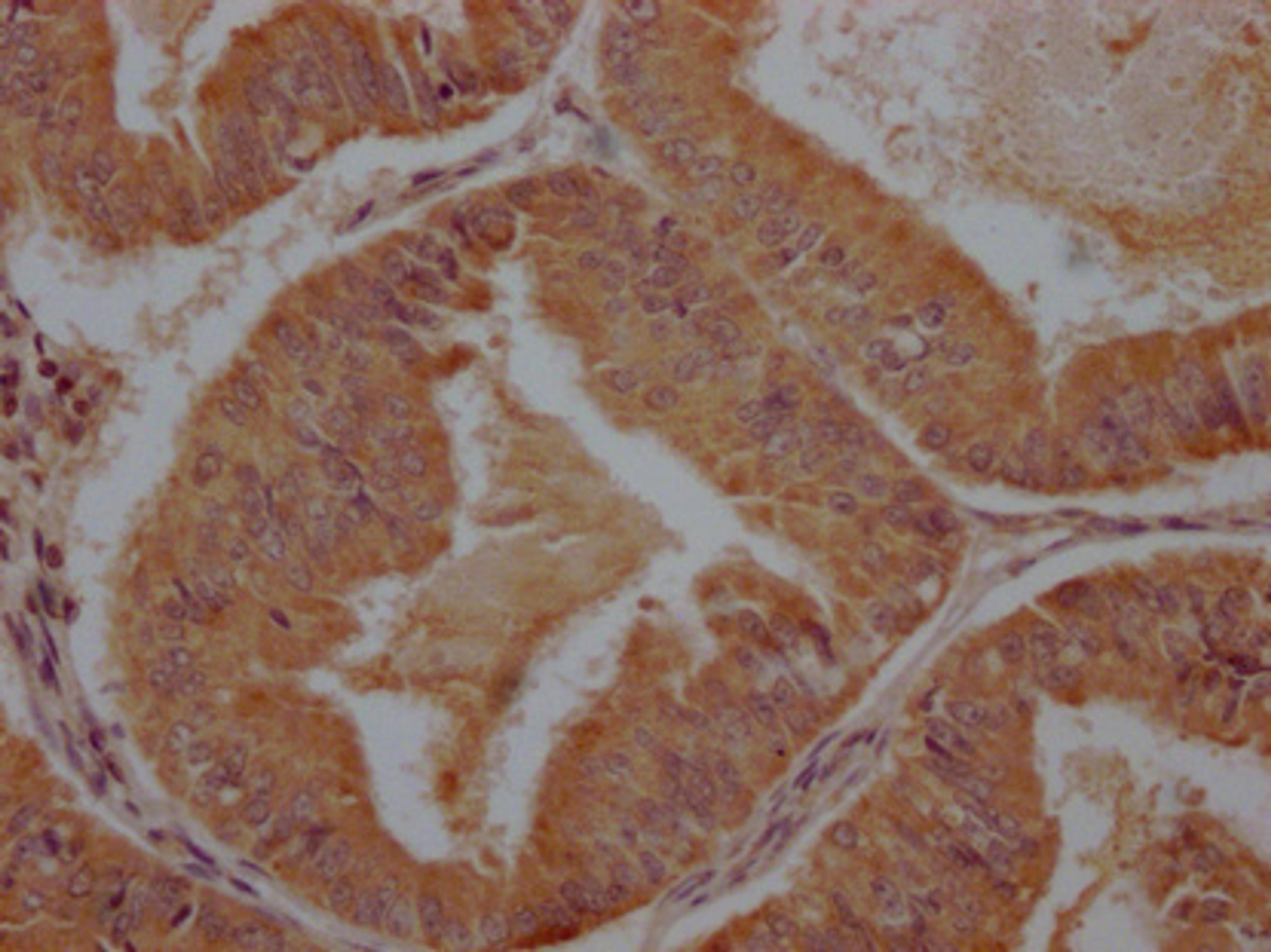 IHC image of CSB-PA28699A0Rb diluted at 1:100 and staining in paraffin-embedded human endometrial cancer performed on a Leica BondTM system. After dewaxing and hydration, antigen retrieval was mediated by high pressure in a citrate buffer (pH 6.0). Section was blocked with 10% normal goat serum 30min at RT. Then primary antibody (1% BSA) was incubated at 4°C overnight. The primary is detected by a Goat anti-rabbit polymer IgG labeled by HRP and visualized using 0.05% DAB.