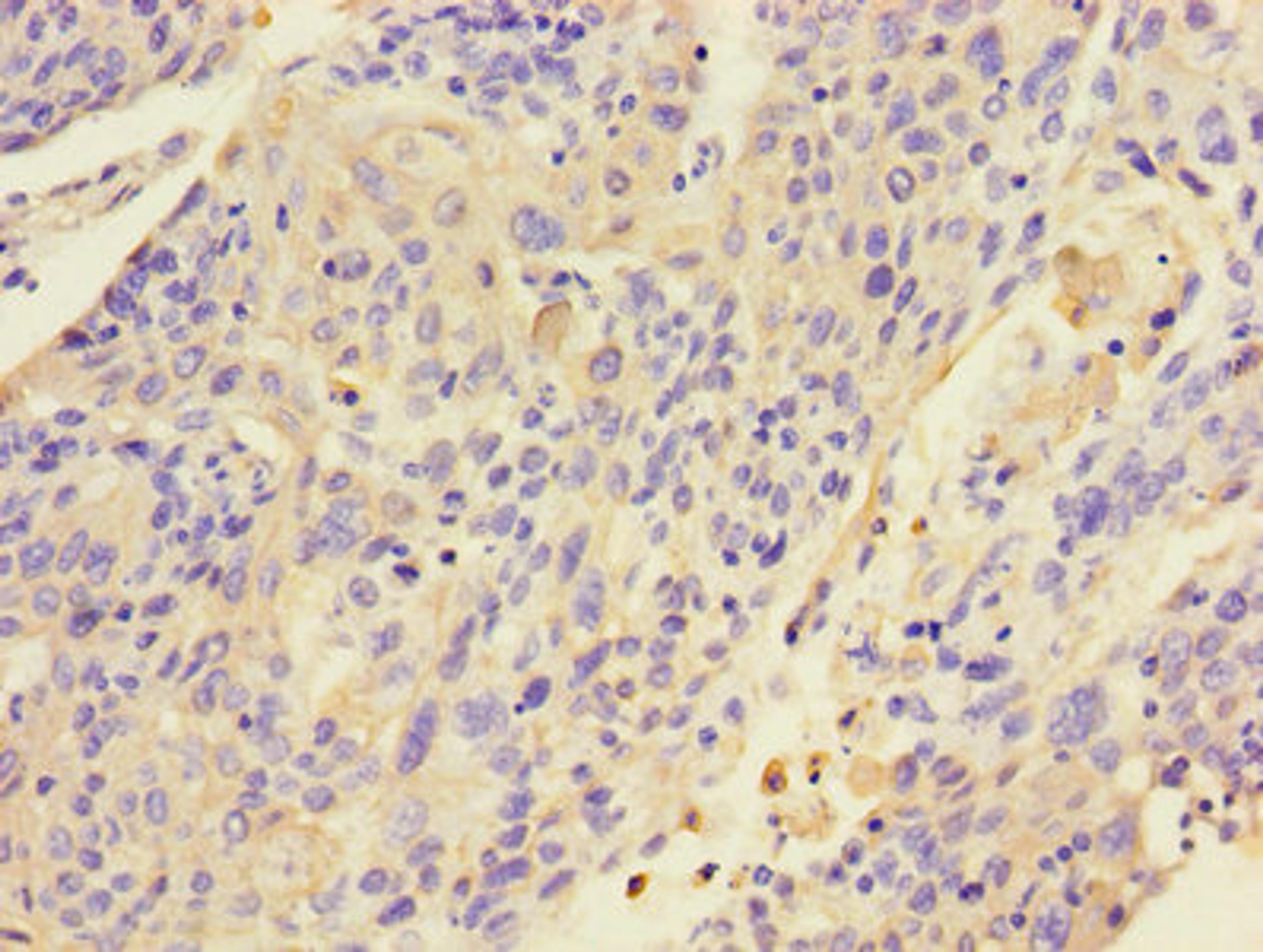 Immunohistochemistry of paraffin-embedded human cervical cancer using CSB-PA012556LA01HU at dilution of 1:100