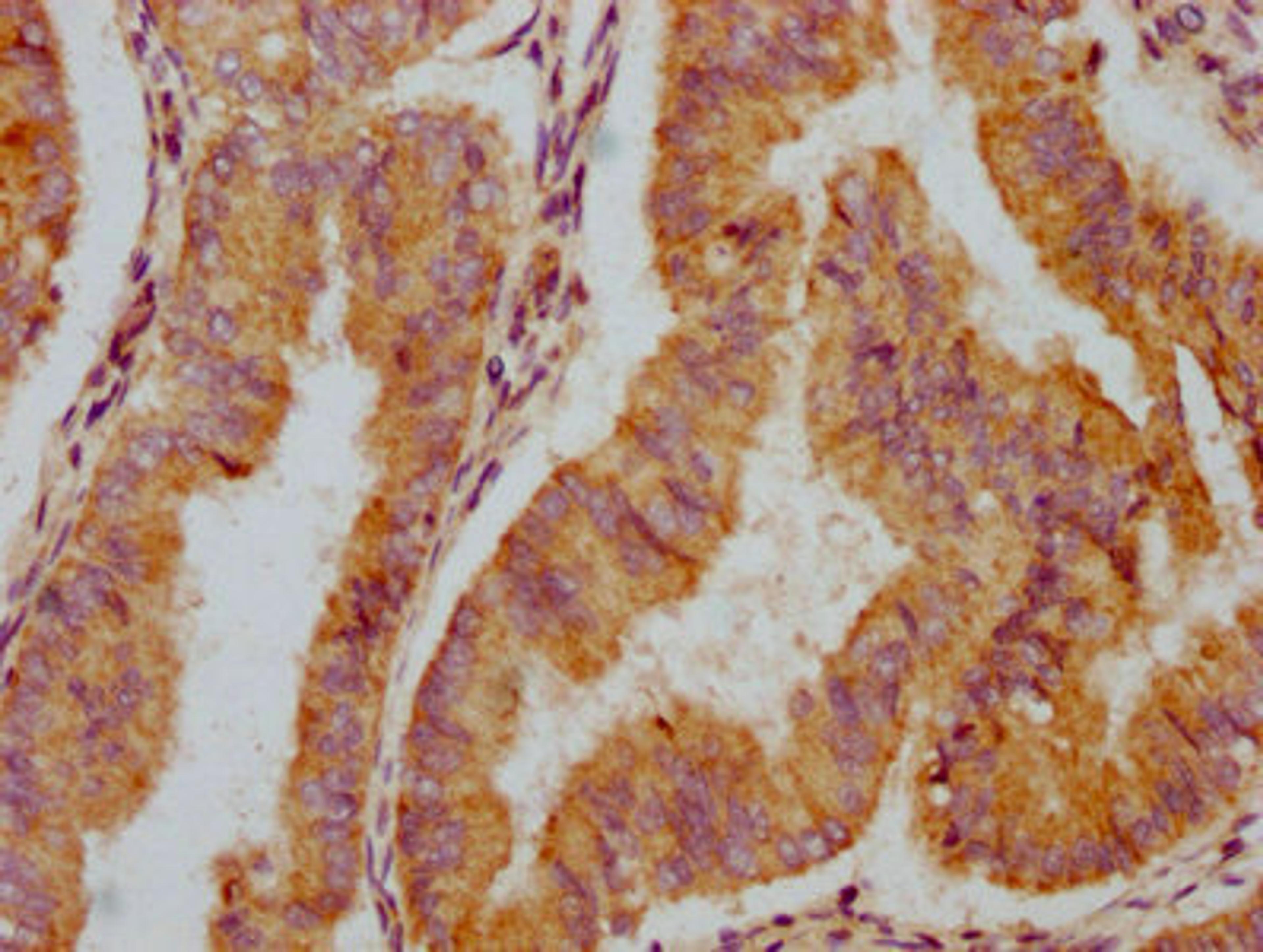 IHC image of CSB-PA818235LA01HU diluted at 1:300 and staining in paraffin-embedded human endometrial cancer performed on a Leica BondTM system. After dewaxing and hydration, antigen retrieval was mediated by high pressure in a citrate buffer (pH 6.0). Section was blocked with 10% normal goat serum 30min at RT. Then primary antibody (1% BSA) was incubated at 4°C overnight. The primary is detected by a biotinylated secondary antibody and visualized using an HRP conjugated SP system.