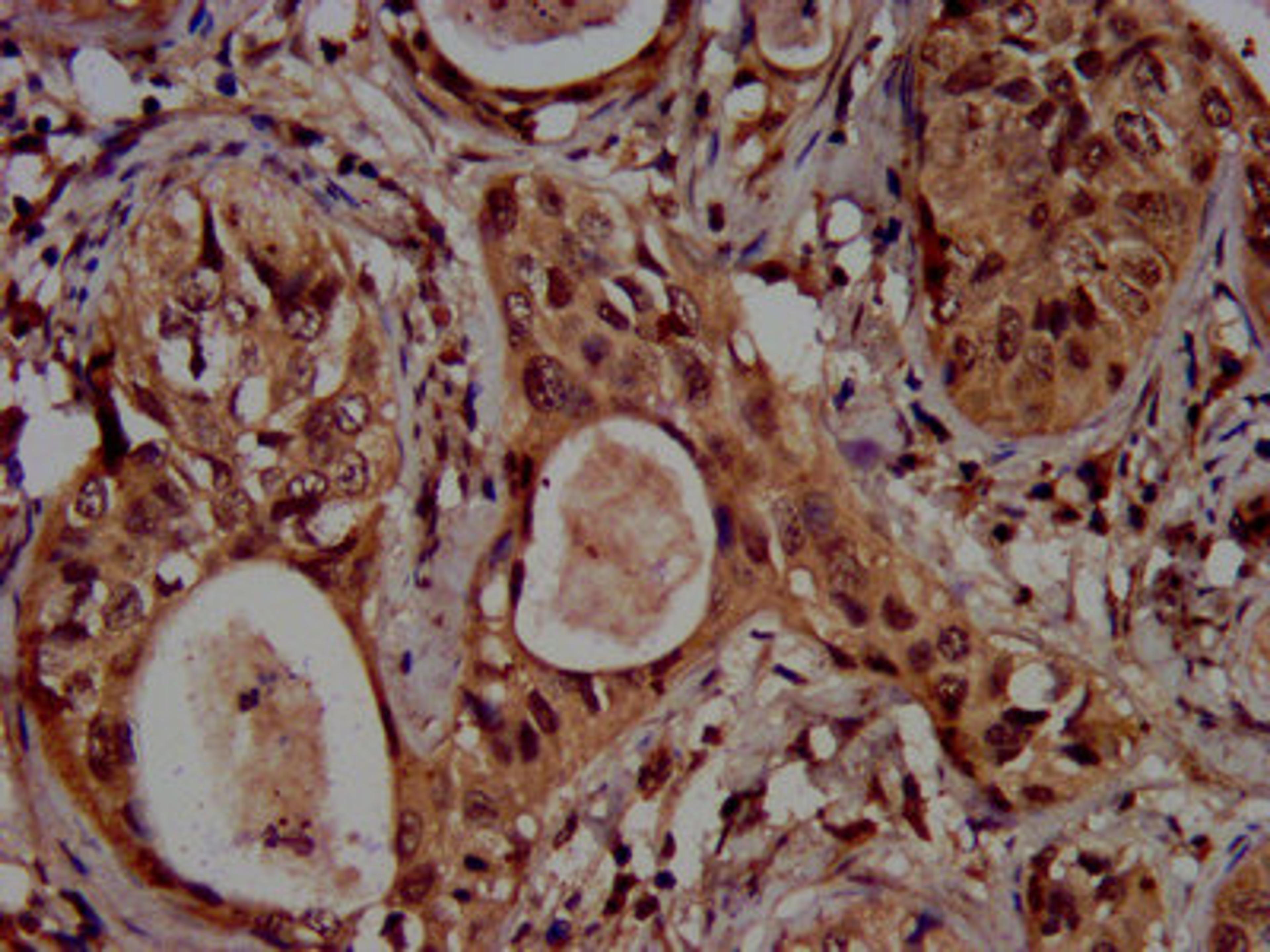 IHC image of CSB-PA010418OA04ncrHU diluted at 1:100 and staining in paraffin-embedded human cervical cancer performed on a Leica BondTM system. After dewaxing and hydration, antigen retrieval was mediated by high pressure in a citrate buffer (pH 6.0). Section was blocked with 10% normal goat serum 30min at RT. Then primary antibody (1% BSA) was incubated at 4&deg;C overnight. The primary is detected by a biotinylated secondary antibody and visualized using an HRP conjugated SP system.