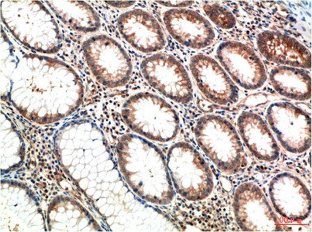 Immunohistochemical analysis of paraffin-embedded Human Colon Carcinoma Tissue using ATM Mouse mAb diluted at 1:200.