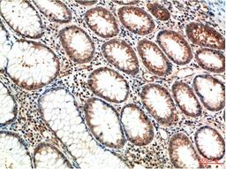 Immunohistochemical analysis of paraffin-embedded Human Colon Carcinoma Tissue using ATM Mouse mAb diluted at 1:200.