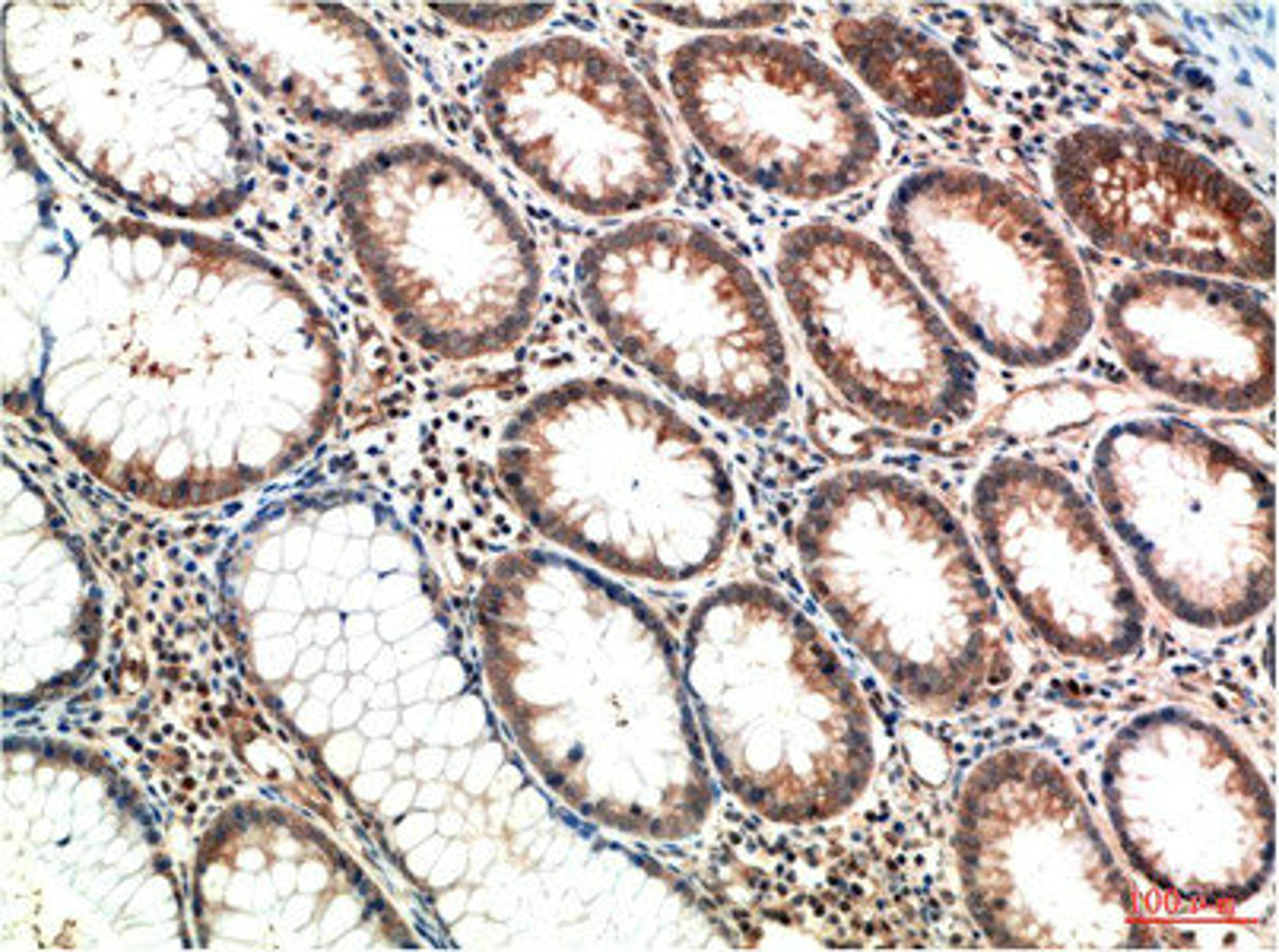 Immunohistochemical analysis of paraffin-embedded Human Colon Carcinoma Tissue using ATM Mouse mAb diluted at 1:200.