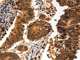 The image on the left is immunohistochemistry of paraffin-embedded Human colon cancer tissue using CSB-PA217880(ADAP1 Antibody) at dilution 1/60, on the right is treated with fusion protein. (Original magnification: ×200)