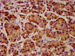 IHC image of CSB-PA836246LA01HU diluted at 1:1000 and staining in paraffin-embedded human pancreatic cancer performed on a Leica BondTM system. After dewaxing and hydration, antigen retrieval was mediated by high pressure in a citrate buffer (pH 6.0). Section was blocked with 10% normal goat serum 30min at RT. Then primary antibody (1% BSA) was incubated at 4°C overnight. The primary is detected by a biotinylated secondary antibody and visualized using an HRP conjugated SP system.