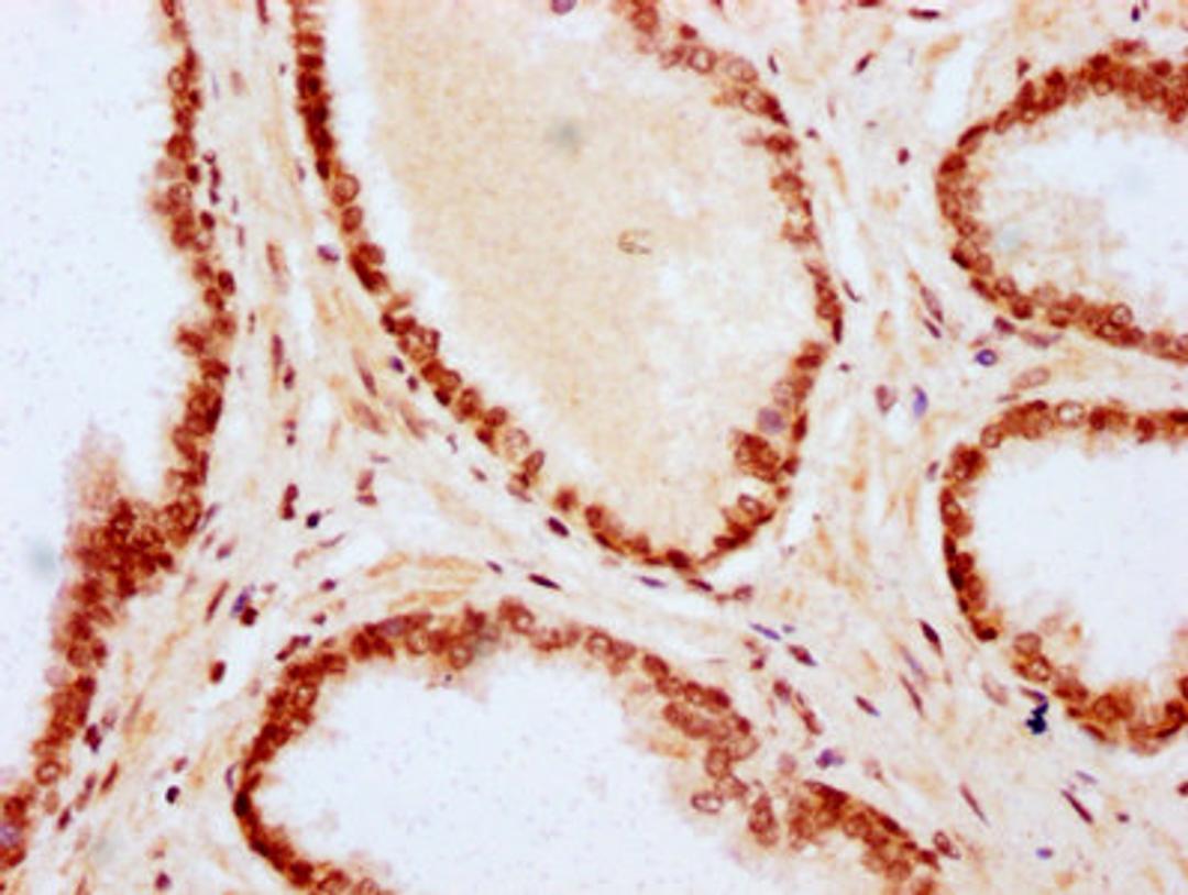 IHC image of CSB-PA010403OA79nme1HU diluted at 1:20 and staining in paraffin-embedded human prostate cancer performed on a Leica BondTM system. After dewaxing and hydration, antigen retrieval was mediated by high pressure in a citrate buffer (pH 6.0). Section was blocked with 10% normal goat serum 30min at RT. Then primary antibody (1% BSA) was incubated at 4&deg;C overnight. The primary is detected by a biotinylated secondary antibody and visualized using an HRP conjugated SP system.