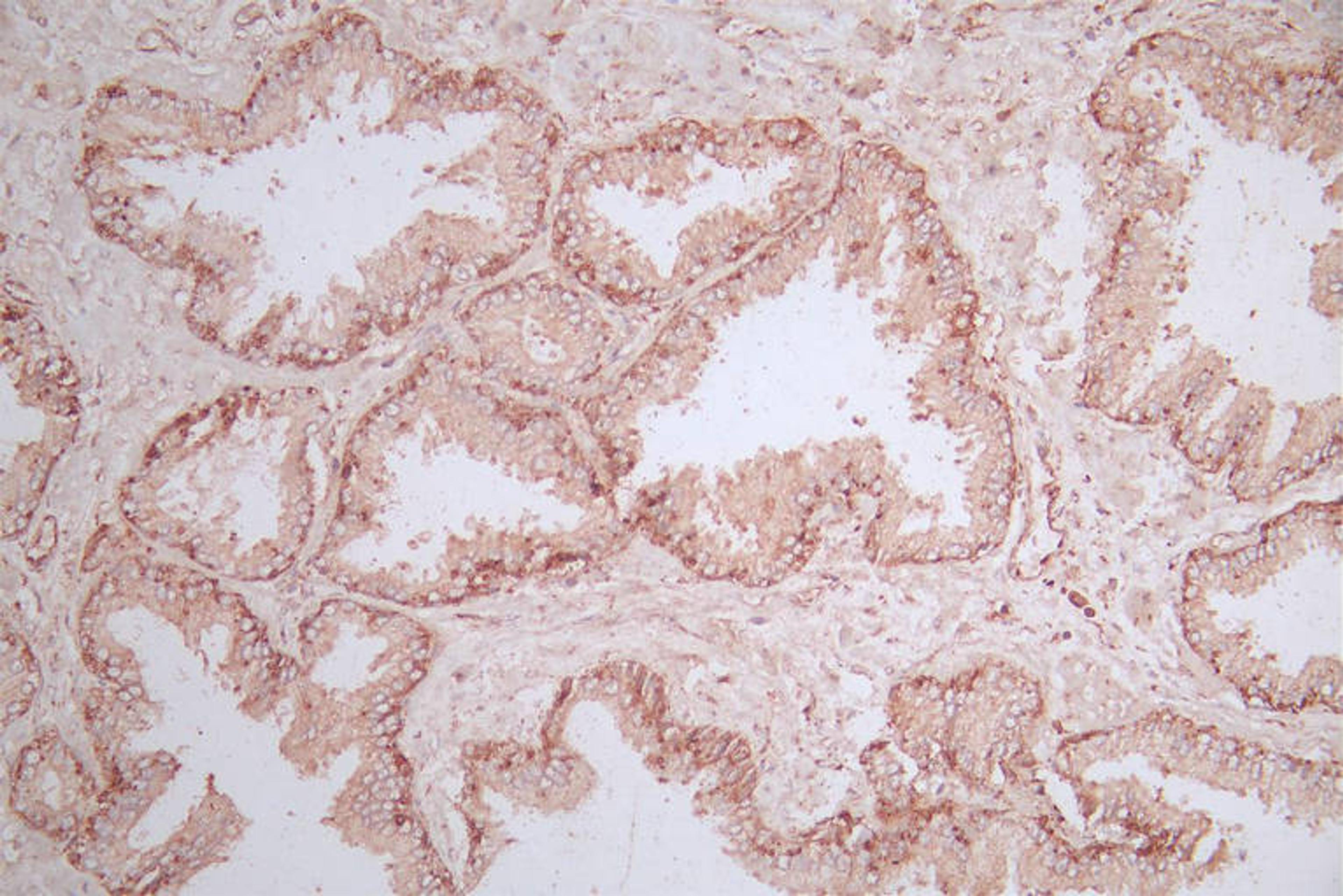 IHC image of CSB-RA014781MA1HU diluted at 1:600 and staining in paraffin-embedded human prostate tissue performed on a Leica BondTM system. After dewaxing and hydration, antigen retrieval was mediated by high pressure in a citrate buffer (pH 6.0). Section was blocked with 10% normal goat serum 30min at RT. Then primary antibody (1% BSA) was incubated at 4°C overnight. The primary is detected by a Goat anti-Mouse IgG labeled by HRP and visualized using 0.05% DAB.